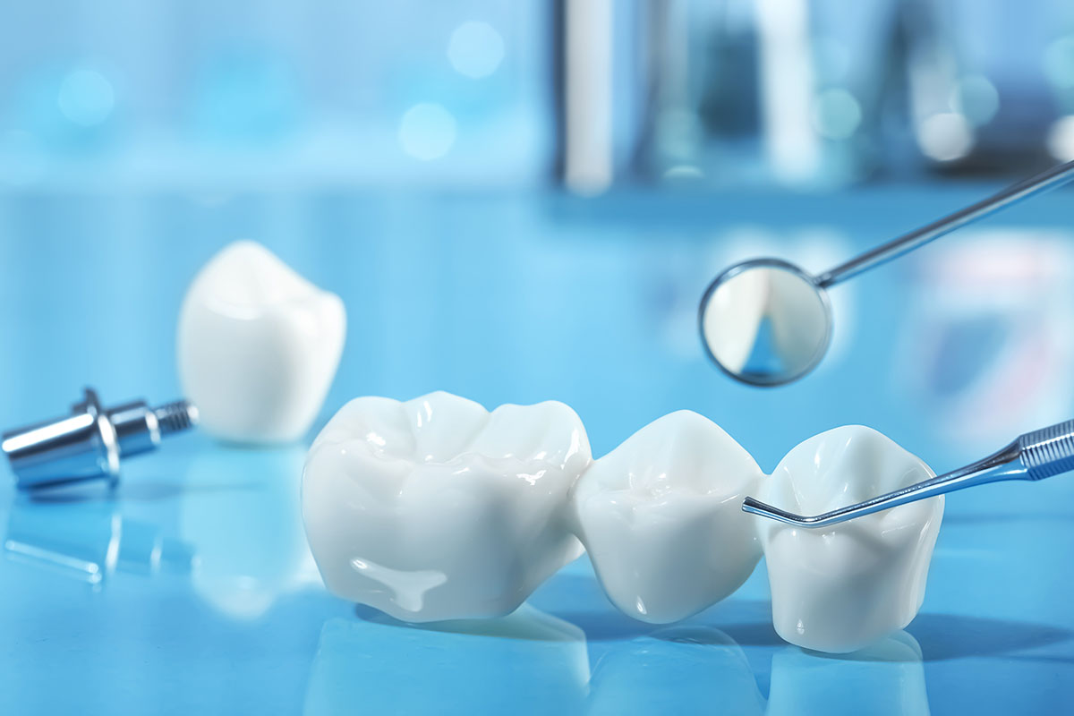 dental crowns same day toronto