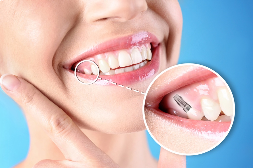 Dental Implants